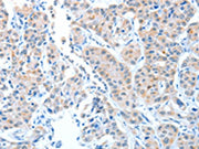 The image on the left is immunohistochemistry of paraffin-embedded Human lung cancer tissue using CSB-PA131728(ADAMTSL1 Antibody) at dilution 1/25, on the right is treated with fusion protein. (Original magnification: ×200)
