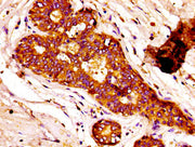 IHC image of CSB-PA13179A0Rb diluted at 1:100 and staining in paraffin-embedded human breast cancer performed on a Leica BondTM system. After dewaxing and hydration, antigen retrieval was mediated by high pressure in a citrate buffer (pH 6.0). Sec...