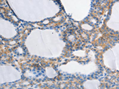 The image on the left is immunohistochemistry of paraffin-embedded Human thyroid cancer tissue using CSB-PA131838(MUC13 Antibody) at dilution 1/30, on the right is treated with synthetic peptide. (Original magnification: ×200)