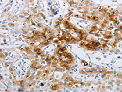 The image on the left is immunohistochemistry of paraffin-embedded Human lung cancer tissue using CSB-PA131945(NPY2R Antibody) at dilution 1/20, on the right is treated with synthetic peptide. (Original magnification: ×200)
