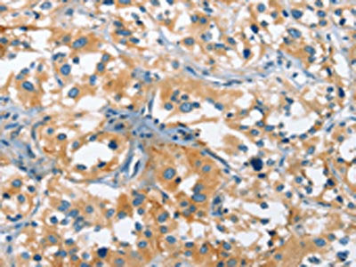 The image on the left is immunohistochemistry of paraffin-embedded Human thyroid cancer tissue using CSB-PA132003(CACNA1C Antibody) at dilution 1/20, on the right is treated with synthetic peptide. (Original magnification: ×200)