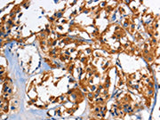 The image on the left is immunohistochemistry of paraffin-embedded Human thyroid cancer tissue using CSB-PA132121(HK2 Antibody) at dilution 1/60, on the right is treated with fusion protein. (Original magnification: X200)
