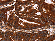 The image on the left is immunohistochemistry of paraffin-embedded Human colon cancer tissue using CSB-PA132284(GCKR Antibody) at dilution 1/50, on the right is treated with synthetic peptide. (Original magnification: ×200)