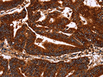 The image on the left is immunohistochemistry of paraffin-embedded Human colon cancer tissue using CSB-PA132284(GCKR Antibody) at dilution 1/50, on the right is treated with synthetic peptide. (Original magnification: ×200)