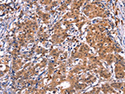 The image on the left is immunohistochemistry of paraffin-embedded Human gastic cancer tissue using CSB-PA132302(GCG Antibody) at dilution 1/40, on the right is treated with synthetic peptide. (Original magnification: ×200)