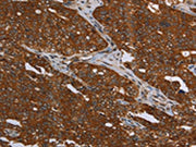 The image on the left is immunohistochemistry of paraffin-embedded Human ovarian cancer tissue using CSB-PA132314(MCHR1 Antibody) at dilution 1/30, on the right is treated with synthetic peptide. (Original magnification: ×200)