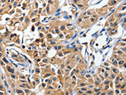 The image on the left is immunohistochemistry of paraffin-embedded Human lung cancer tissue using CSB-PA132342(DUSP8 Antibody) at dilution 1/40, on the right is treated with synthetic peptide. (Original magnification: ×200)
