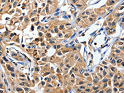The image on the left is immunohistochemistry of paraffin-embedded Human lung cancer tissue using CSB-PA132342(DUSP8 Antibody) at dilution 1/40, on the right is treated with synthetic peptide. (Original magnification: ×200)