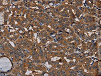 The image on the left is immunohistochemistry of paraffin-embedded Human thyroid cancer tissue using CSB-PA132496(PDE5A Antibody) at dilution 1/50, on the right is treated with synthetic peptide. (Original magnification: ×200)