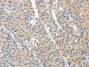 The image on the left is immunohistochemistry of paraffin-embedded Human liver cancer tissue using CSB-PA132606(SLC20A1 Antibody) at dilution 1/40, on the right is treated with synthetic peptide. (Original magnification: ×200)