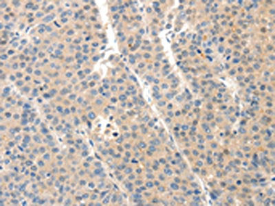 The image on the left is immunohistochemistry of paraffin-embedded Human liver cancer tissue using CSB-PA132606(SLC20A1 Antibody) at dilution 1/40, on the right is treated with synthetic peptide. (Original magnification: ×200)
