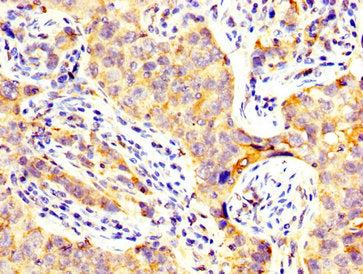 IHC image of CSB-PA13269A0Rb diluted at 1:300 and staining in paraffin-embedded human pancreatic cancer performed on a Leica BondTM system. After dewaxing and hydration, antigen retrieval was mediated by high pressure in a citrate buffer (pH 6.0)....