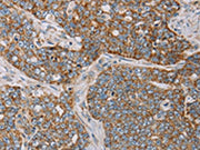 The image on the left is immunohistochemistry of paraffin-embedded Human cervical cancer tissue using CSB-PA132736(MTFP1 Antibody) at dilution 1/20, on the right is treated with fusion protein. (Original magnification: ×200)