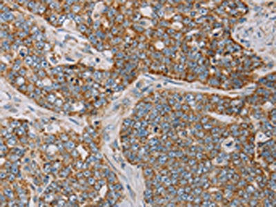The image on the left is immunohistochemistry of paraffin-embedded Human cervical cancer tissue using CSB-PA132736(MTFP1 Antibody) at dilution 1/20, on the right is treated with fusion protein. (Original magnification: ×200)