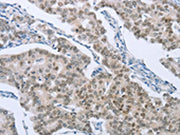 The image on the left is immunohistochemistry of paraffin-embedded Human breast cancer tissue using CSB-PA132836(FOXA1 Antibody) at dilution 1/50, on the right is treated with synthetic peptide. (Original magnification: ×200)