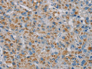 The image on the left is immunohistochemistry of paraffin-embedded Human liver cancer tissue using CSB-PA132878(PNLIP Antibody) at dilution 1/20, on the right is treated with fusion protein. (Original magnification: ×200)