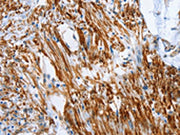 The image on the left is immunohistochemistry of paraffin-embedded Human colon cancer tissue using CSB-PA132880(SHROOM2 Antibody) at dilution 1/50, on the right is treated with synthetic peptide. (Original magnification: ×200)