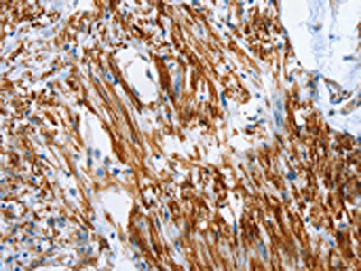 The image on the left is immunohistochemistry of paraffin-embedded Human colon cancer tissue using CSB-PA132880(SHROOM2 Antibody) at dilution 1/50, on the right is treated with synthetic peptide. (Original magnification: ×200)