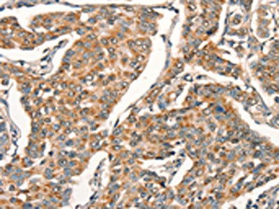 The image on the left is immunohistochemistry of paraffin-embedded Human breast cancer tissue using CSB-PA133087(ARFRP1 Antibody) at dilution 1/25, on the right is treated with synthetic peptide. (Original magnification: ×200)