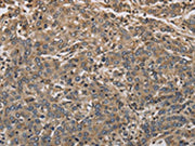 The image on the left is immunohistochemistry of paraffin-embedded Human liver cancer tissue using CSB-PA133169(KCNA7 Antibody) at dilution 1/40, on the right is treated with synthetic peptide. (Original magnification: ×200)