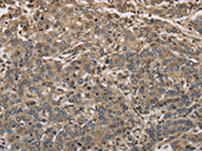 The image on the left is immunohistochemistry of paraffin-embedded Human liver cancer tissue using CSB-PA133169(KCNA7 Antibody) at dilution 1/40, on the right is treated with synthetic peptide. (Original magnification: ×200)