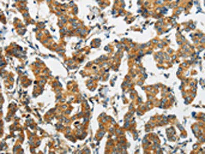 The image on the left is immunohistochemistry of paraffin-embedded Human breast cancer tissue using CSB-PA133408(FABP2 Antibody) at dilution 1/30, on the right is treated with fusion protein. (Original magnification: ×200)