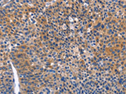 The image on the left is immunohistochemistry of paraffin-embedded Human liver cancer tissue using CSB-PA133439(ARRB1 Antibody) at dilution 1/50, on the right is treated with fusion protein. (Original magnification: ×200)