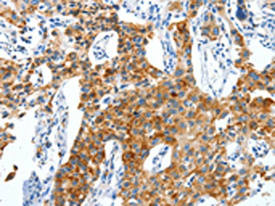 The image on the left is immunohistochemistry of paraffin-embedded Human lung cancer tissue using CSB-PA133590(CKAP4 Antibody) at dilution 1/50, on the right is treated with synthetic peptide. (Original magnification: ×200)