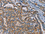 The image is immunohistochemistry of paraffin-embedded Human thyroid cancer tissue using CSB-PA133615(TAB3 Antibody) at dilution 1/25. (Original magnification: ×200)