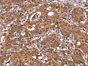 The image on the left is immunohistochemistry of paraffin-embedded Human gastic cancer tissue using CSB-PA133916(HMGCS1 Antibody) at dilution 1/40, on the right is treated with synthetic peptide. (Original magnification: ×200)