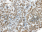 The image on the left is immunohistochemistry of paraffin-embedded Human breast cancer tissue using CSB-PA133989(TRIM27 Antibody) at dilution 1/35, on the right is treated with synthetic peptide. (Original magnification: ×200)