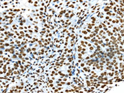 The image on the left is immunohistochemistry of paraffin-embedded Human breast cancer tissue using CSB-PA133989(TRIM27 Antibody) at dilution 1/35, on the right is treated with synthetic peptide. (Original magnification: ×200)