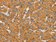 The image on the left is immunohistochemistry of paraffin-embedded Human liver cancer tissue using CSB-PA133992(SNX11 Antibody) at dilution 1/30, on the right is treated with fusion protein. (Original magnification: ×200)