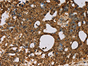 The image on the left is immunohistochemistry of paraffin-embedded Human cervical cancer tissue using CSB-PA134529(PSMC2 Antibody) at dilution 1/30, on the right is treated with fusion protein. (Original magnification: ×200)