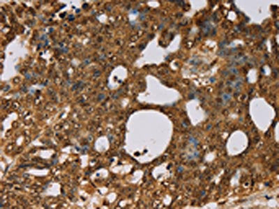The image on the left is immunohistochemistry of paraffin-embedded Human cervical cancer tissue using CSB-PA134529(PSMC2 Antibody) at dilution 1/30, on the right is treated with fusion protein. (Original magnification: ×200)