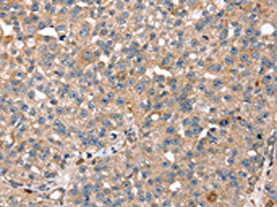 The image on the left is immunohistochemistry of paraffin-embedded Human breast cancer tissue using CSB-PA134767(RNF11 Antibody) at dilution 1/40, on the right is treated with fusion protein. (Original magnification: ×200)