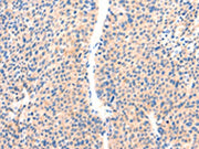 The image on the left is immunohistochemistry of paraffin-embedded Human liver cancer tissue using CSB-PA134978(PAFAH2 Antibody) at dilution 1/80, on the right is treated with synthetic peptide. (Original magnification: ×200)