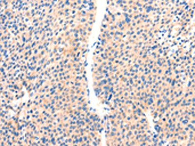 The image on the left is immunohistochemistry of paraffin-embedded Human liver cancer tissue using CSB-PA134978(PAFAH2 Antibody) at dilution 1/80, on the right is treated with synthetic peptide. (Original magnification: ×200)