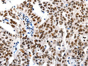The image on the left is immunohistochemistry of paraffin-embedded Human ovarian cancer tissue using CSB-PA134980(HDAC1 Antibody) at dilution 1/20, on the right is treated with synthetic peptide. (Original magnification: ×200)