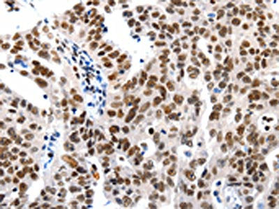 The image on the left is immunohistochemistry of paraffin-embedded Human ovarian cancer tissue using CSB-PA134980(HDAC1 Antibody) at dilution 1/20, on the right is treated with synthetic peptide. (Original magnification: ×200)