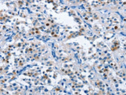 The image on the left is immunohistochemistry of paraffin-embedded Human thyroid cancer tissue using CSB-PA135119(MCM7 Antibody) at dilution 1/40, on the right is treated with fusion protein. (Original magnification: ×200)