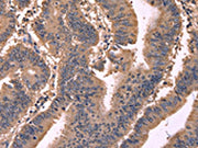 The image on the left is immunohistochemistry of paraffin-embedded Human colon cancer tissue using CSB-PA135172(GCG Antibody) at dilution 1/20, on the right is treated with synthetic peptide. (Original magnification: ×200)