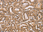 The image on the left is immunohistochemistry of paraffin-embedded Human thyroid cancer tissue using CSB-PA135204(BGLAP Antibody) at dilution 1/40, on the right is treated with synthetic peptide. (Original magnification: ×200)