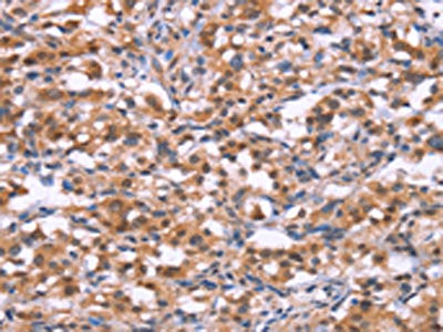 The image on the left is immunohistochemistry of paraffin-embedded Human thyroid cancer tissue using CSB-PA135237(BRK1 Antibody) at dilution 1/30, on the right is treated with synthetic peptide. (Original magnification: ×200)