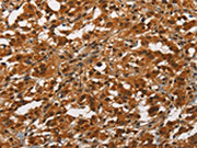 The image on the left is immunohistochemistry of paraffin-embedded Human thyroid cancer tissue using CSB-PA135409(ANAPC4 Antibody) at dilution 1/50, on the right is treated with synthetic peptide. (Original magnification: ×200)