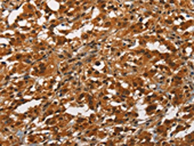 The image on the left is immunohistochemistry of paraffin-embedded Human thyroid cancer tissue using CSB-PA135409(ANAPC4 Antibody) at dilution 1/50, on the right is treated with synthetic peptide. (Original magnification: ×200)