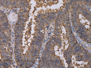 The image on the left is immunohistochemistry of paraffin-embedded Human colon cancer tissue using CSB-PA135431(REG3G Antibody) at dilution 1/40, on the right is treated with fusion protein. (Original magnification: ×200)