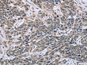 The image on the left is immunohistochemistry of paraffin-embedded Human cervical cancer tissue using CSB-PA135769(ESR2 Antibody) at dilution 1/30, on the right is treated with fusion protein. (Original magnification: ×200)