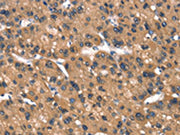 The image on the left is immunohistochemistry of paraffin-embedded Human liver cancer tissue using CSB-PA135938(DAAM1 Antibody) at dilution 1/40, on the right is treated with synthetic peptide. (Original magnification: ×200)