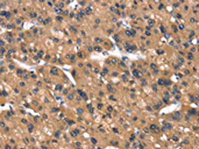 The image on the left is immunohistochemistry of paraffin-embedded Human liver cancer tissue using CSB-PA135938(DAAM1 Antibody) at dilution 1/40, on the right is treated with synthetic peptide. (Original magnification: ×200)